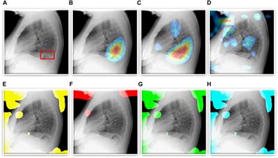 Detecting Tuberculosis-Consistent Findings in Lateral Chest X-Rays Using an Ensemble of CNNs and Vision Transformers